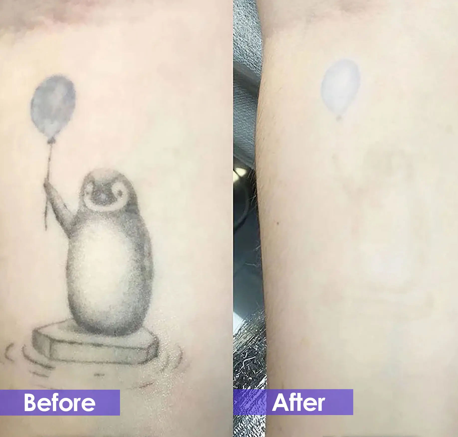 q-switch laser before and after - Penguin Tattoo Removal